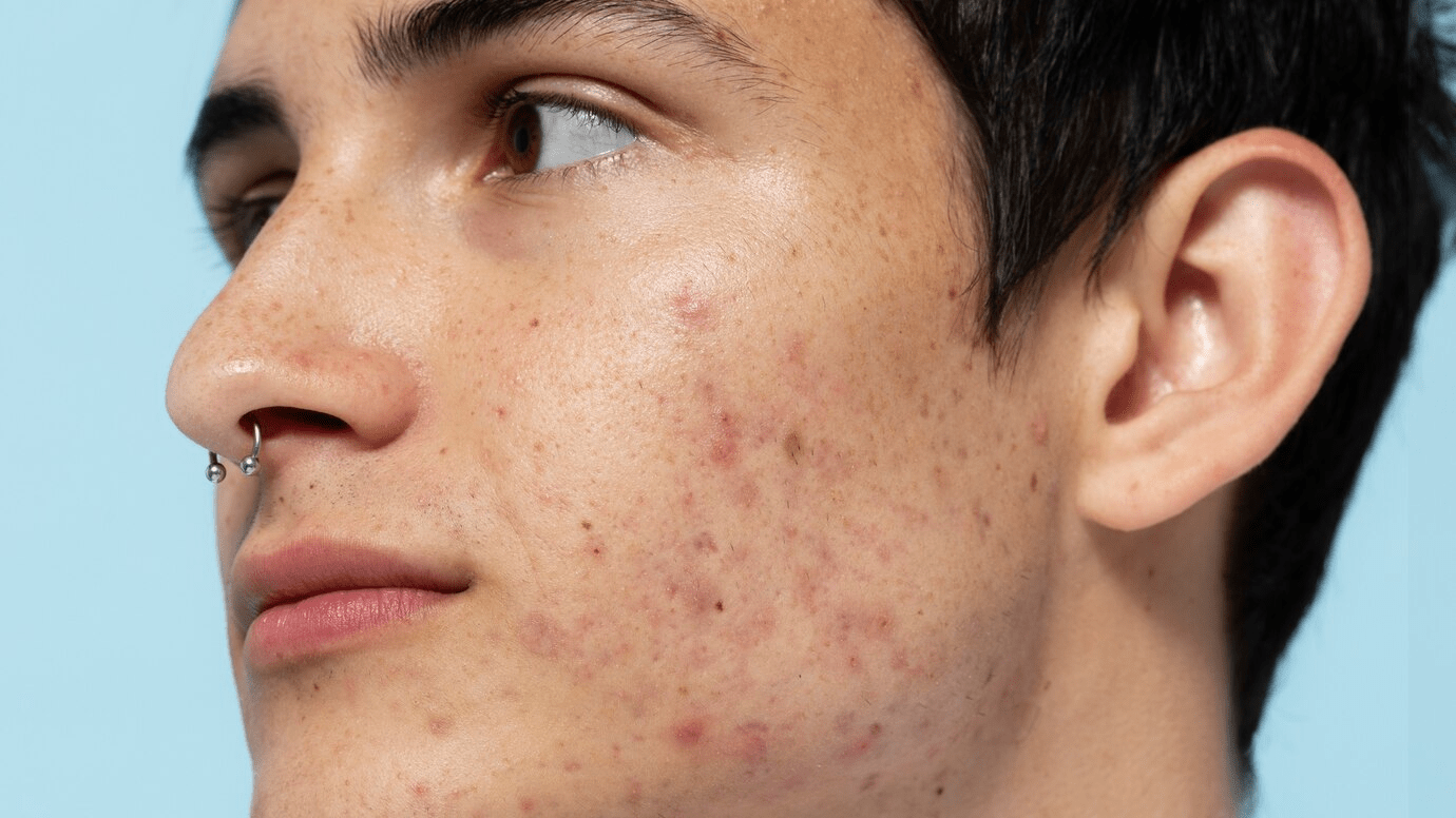 Acne free skin (Image Source : FREEPIK)